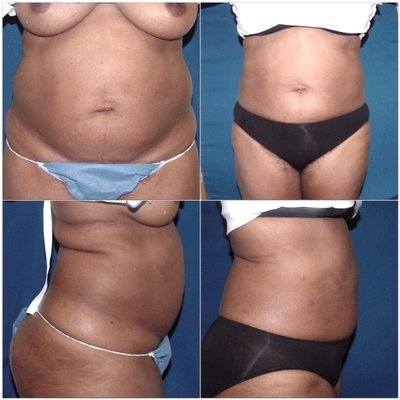 Lipo selection/Lipo suction - Beast Liposuction in Los Angeles County. Call Dr Pearlman Hicks for a free consultation at 562-595-9493 Lipo selection/Lipo suction - Beast Liposuction in Los Angeles County. Call Dr Pearlman Hicks for a free consultation at 562-595-9493
