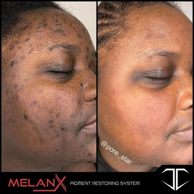 MelanX - Level 2 Chemical peel - Ready to fade away dark marks, hyperpigmentation, or dull-looking skin? Our MelanX is the most advanced prescription strength chemical peel and skin-lightening system on the market. It is designed to help penetrate deep into the skin to lift and lighten unwanted dark marks, hyperpigmentation, sun damage, melasma and uneven skin tone. MelanX - Level 2 Chemical peel - Ready to fade away dark marks, hyperpigmentation, or dull-looking skin? Our MelanX is the most advanced prescription strength chemical peel and skin-lightening system on the market. It is designed to help penetrate deep into the skin to lift and lighten unwanted dark marks, hyperpigmentation, sun damage, melasma and uneven skin tone.