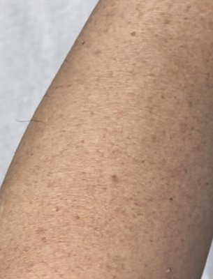 Remove brown spots with our Signature Luminate laser treatment. - This is an example of results from the Signature Luminate laser treatment performed here at IDD Aesthetics. Results will vary. Remove brown spots with our Signature Luminate laser treatment. - This is an example of results from the Signature Luminate laser treatment performed here at IDD Aesthetics. Results will vary.