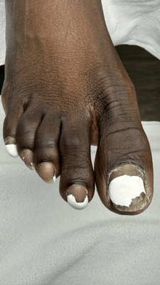 Medical Pedicure & Callus Removal - This client visited MedPedicure Center experiencing discomfort from severe calluses and neglected nails. Our certified specialists performed a comprehensive, painless medical pedicure using strictly sterilized equipment. We safely treated the problem areas without damaging healthy tissue and provided consultation on proper home care. The result: completely restored, healthy, and smooth feet. If you are dealing with foot discomfort or need professional, hygienic podiatry care in Rockville, MD, book your specialized treatment with us today Medical Pedicure & Callus Removal - This client visited MedPedicure Center experiencing discomfort from severe calluses and neglected nails. Our certified specialists performed a comprehensive, painless medical pedicure using strictly sterilized equipment. We safely treated the problem areas without damaging healthy tissue and provided consultation on proper home care. The result: completely restored, healthy, and smooth feet. If you are dealing with foot discomfort or need professional, hygienic podiatry care in Rockville, MD, book your specialized treatment with us today