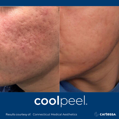 Co2 Laser Treatment - CoolPeel™ is an advanced laser treatment that reduces the appearance of fine lines, sun damage, and pores. It also improves skin texture with little to no downtime. The Tetra CO2 is the only technology that can perform a CoolPeel™ because of the unique pulse control needed. Co2 Laser Treatment - CoolPeel™ is an advanced laser treatment that reduces the appearance of fine lines, sun damage, and pores. It also improves skin texture with little to no downtime. The Tetra CO2 is the only technology that can perform a CoolPeel™ because of the unique pulse control needed.