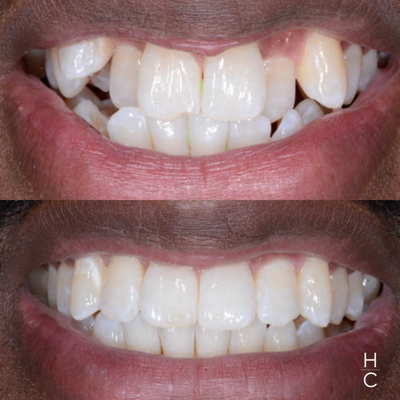Invisalign - Invisalign is the clear alternative to traditional braces. The removable clear aligners allow you to wear them without notice, and remove them for proper cleaning of your teeth and gums. Chicago Dental Studio is the #1 GP Invisalign provider in North America as deemed by Invisalign. All impressions are taken digitally and virtually augmented smile designs are displayed within minutes of scanning, so you can start your treatment immediately. Invisalign - Invisalign is the clear alternative to traditional braces. The removable clear aligners allow you to wear them without notice, and remove them for proper cleaning of your teeth and gums. Chicago Dental Studio is the #1 GP Invisalign provider in North America as deemed by Invisalign. All impressions are taken digitally and virtually augmented smile designs are displayed within minutes of scanning, so you can start your treatment immediately.