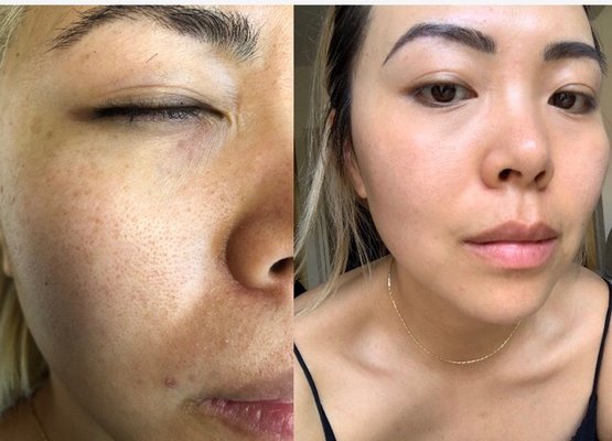 Clear skin club - These treatments were all done within 2 weeks of each other to achieve these results. Our experience technician and unmatched technology made this possible Clear skin club - These treatments were all done within 2 weeks of each other to achieve these results. Our experience technician and unmatched technology made this possible