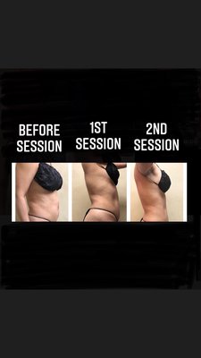 Body Contouring #1 - Body contouring is great for those who want to look good and feel good. Help tighten the skin and break down stubborn fat cells. Body Contouring #1 - Body contouring is great for those who want to look good and feel good. Help tighten the skin and break down stubborn fat cells.