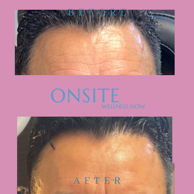 Neurotoxins - Neurotoxin Injections: Smooth, Refreshed, and Rejuvenated
Neurotoxins like Botox®, Daxxify, Jeuveau®, and Xeomin® are FDA-approved injectable treatments used to temporarily relax facial muscles that cause dynamic wrinkles. These fine lines—such as crow’s feet, forehead lines, and frown lines between the brows—form from repeated facial expressions over time.
By relaxing these muscles, neurotoxin treatments soften existing wrinkles and help prevent new ones from forming, giving the face a smoother, more youthful appearance with natural-looking results.
💉 Benefits of Neurotoxin Injections:
Reduce the appearance of fine lines and wrinkles
Prevent deeper expression lines from forming
Fast, virtually painless treatment
No downtime – resume normal activities the same day
Results appear within 3–7 days and last 3–4 months
Ideal for both men and women, neurotoxin treatments are a trusted, effective way to look refreshed, not frozen. Neurotoxins - Neurotoxin Injections: Smooth, Refreshed, and Rejuvenated
Neurotoxins like Botox®, Daxxify, Jeuveau®, and Xeomin® are FDA-approved injectable treatments used to temporarily relax facial muscles that cause dynamic wrinkles. These fine lines—such as crow’s feet, forehead lines, and frown lines between the brows—form from repeated facial expressions over time.
By relaxing these muscles, neurotoxin treatments soften existing wrinkles and help prevent new ones from forming, giving the face a smoother, more youthful appearance with natural-looking results.
💉 Benefits of Neurotoxin Injections:
Reduce the appearance of fine lines and wrinkles
Prevent deeper expression lines from forming
Fast, virtually painless treatment
No downtime – resume normal activities the same day
Results appear within 3–7 days and last 3–4 months
Ideal for both men and women, neurotoxin treatments are a trusted, effective way to look refreshed, not frozen.