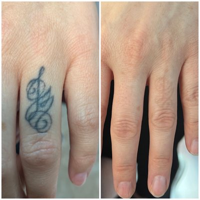 Laser Tattoo Removal - Schedule a free consultation with the INK ERASER to remove those unwanted tattoos or permanent makeup that did not turn out like you wanted. Safe and no skin damage. Using the latest technology we are able to get faster tattoo clearance
Follow us on TikTok, Instagram & YouTube : Inkeraser Laser Tattoo Removal - Schedule a free consultation with the INK ERASER to remove those unwanted tattoos or permanent makeup that did not turn out like you wanted. Safe and no skin damage. Using the latest technology we are able to get faster tattoo clearance
Follow us on TikTok, Instagram & YouTube : Inkeraser