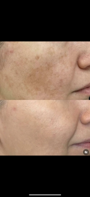 Melasma and pigmentation - Patient"s who has been treated at Radiant Med Spa with Pico laser to improve pigmentation Melasma and pigmentation - Patient"s who has been treated at Radiant Med Spa with Pico laser to improve pigmentation