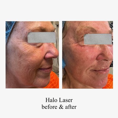 HALO+PRP Bring Back Your GLOW - Start the new year with expert RN aesthetic care focused on natural, confident results. For a limited time, enjoy 5% off RN aesthetic treatments - Halo, BBL, Botox, Microneedling, Hair Restoration, Facials, Peels, more. Thoughtful technique, medical precision, and skin-first philosophy—because your skin deserves trusted hands. Book your 2026 refresh today. HALO+PRP Bring Back Your GLOW - Start the new year with expert RN aesthetic care focused on natural, confident results. For a limited time, enjoy 5% off RN aesthetic treatments - Halo, BBL, Botox, Microneedling, Hair Restoration, Facials, Peels, more. Thoughtful technique, medical precision, and skin-first philosophy—because your skin deserves trusted hands. Book your 2026 refresh today.