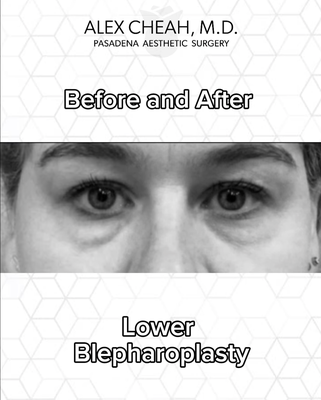 Lower Blepharoplasty (Eyelid) - A lower eyelid lift can offer a dramatic difference and make a huge improvement to your daily routine especially if you’re constantly trying to cover up circles or bags! Lower Blepharoplasty (Eyelid) - A lower eyelid lift can offer a dramatic difference and make a huge improvement to your daily routine especially if you’re constantly trying to cover up circles or bags!