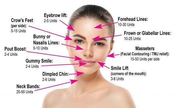Botox or Xeomin-How many units are typically used - This is an example of how many units of Botox or Xeomin are typically used