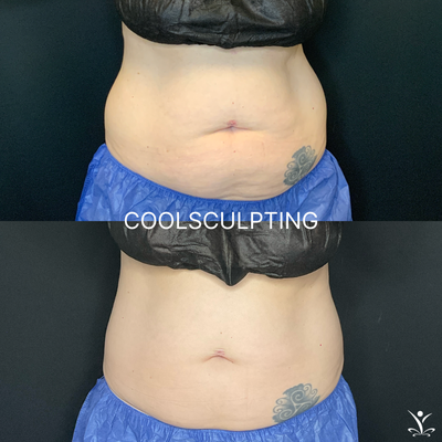 CoolSculpting Before & After's - CoolSculpting before and after photos. CoolSculpting Before & After's - CoolSculpting before and after photos.
