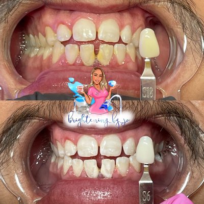 Cosmetic Teeth Whitening - Before and after Real Results Guaranteed Cosmetic Teeth Whitening - Before and after Real Results Guaranteed