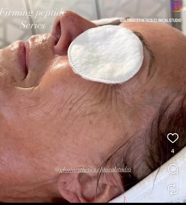 Firming peptide facial treatment series of 6 weekly sessions. Results - ✨ Featuring this stunning before & after by @glowaesthetics.clinicalstudio ✨
This beautiful client came to us with sun damage, visible signs of aging, dullness, and sagging skin. She had never used clinical-grade skincare and wanted true rejuvenation. 💎
After a thorough skin analysis + consultation, we customized an in-clinic treatment plan and paired it with a clinical-grade homecare routine. And just look at her glow now—rejuvenation is possible when you trust the process! 🌸
💖 Experience the ultimate in firming & tightening with our Professional Firming Peptide Facial – Series of 6:
✔ Harnesses advanced peptide + antioxidant science
✔ Stimulates microcirculation & dermal regeneration
✔ Detoxifies & revitalizes dull, tired skin
✔ Firms, lifts, and tightens instantly & progressively
Perfect for anyone noticing advanced signs of aging, UV damage, loss of elasticity, and dullness.
📲 Book your Firming Peptide Facial Series today!
Call/text: 951-760-2340
🔗 Link for all treatments is in our bio.
#ClinicalAesthetician #LicensedEsthetician #FirmingPeptideFacials #AntiAgingSkincare #TemeculaSkin #WineCountryGlow #GlowAesthetics Firming peptide facial treatment series of 6 weekly sessions. Results - ✨ Featuring this stunning before & after by @glowaesthetics.clinicalstudio ✨
This beautiful client came to us with sun damage, visible signs of aging, dullness, and sagging skin. She had never used clinical-grade skincare and wanted true rejuvenation. 💎
After a thorough skin analysis + consultation, we customized an in-clinic treatment plan and paired it with a clinical-grade homecare routine. And just look at her glow now—rejuvenation is possible when you trust the process! 🌸
💖 Experience the ultimate in firming & tightening with our Professional Firming Peptide Facial – Series of 6:
✔ Harnesses advanced peptide + antioxidant science
✔ Stimulates microcirculation & dermal regeneration
✔ Detoxifies & revitalizes dull, tired skin
✔ Firms, lifts, and tightens instantly & progressively
Perfect for anyone noticing advanced signs of aging, UV damage, loss of elasticity, and dullness.
📲 Book your Firming Peptide Facial Series today!
Call/text: 951-760-2340
🔗 Link for all treatments is in our bio.
#ClinicalAesthetician #LicensedEsthetician #FirmingPeptideFacials #AntiAgingSkincare #TemeculaSkin #WineCountryGlow #GlowAesthetics