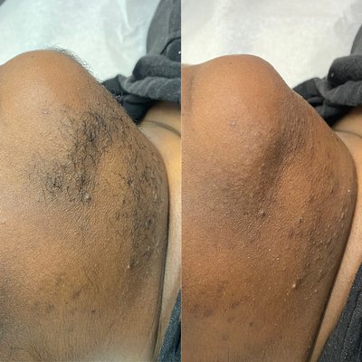 Full body waxing before and after photos - These are before and after pictures from the chin down to the legs. Full body waxing before and after photos - These are before and after pictures from the chin down to the legs.