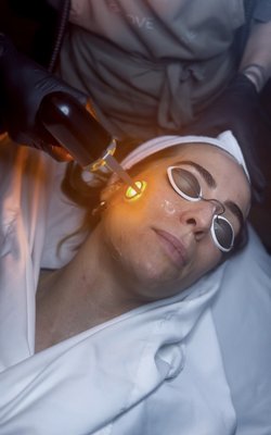 ADVATx® Laser - Whether you're dealing with rosacea, redness, hyperpigmentation, stubborn acne, scarring, wrinkles, or uneven texture, ADVATx laser treatment at Grove and Kane offers clinically proven results with minimal downtime ADVATx® Laser - Whether you're dealing with rosacea, redness, hyperpigmentation, stubborn acne, scarring, wrinkles, or uneven texture, ADVATx laser treatment at Grove and Kane offers clinically proven results with minimal downtime