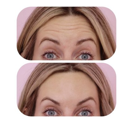 Botox - Botox cosmetic face injection works by using a toxin called botulinum toxin to block nerve muscles responsible for forming wrinkles. When injected into the treatment area, the facial muscles start to relax and soften. The lack of muscle movement prevents wrinkles from appearing. This temporarily lasts from 3-6 months after the procedure. Results can start to show anywhere between 3 to 5 days, with full effects showing around 10 days. Botox - Botox cosmetic face injection works by using a toxin called botulinum toxin to block nerve muscles responsible for forming wrinkles. When injected into the treatment area, the facial muscles start to relax and soften. The lack of muscle movement prevents wrinkles from appearing. This temporarily lasts from 3-6 months after the procedure. Results can start to show anywhere between 3 to 5 days, with full effects showing around 10 days.