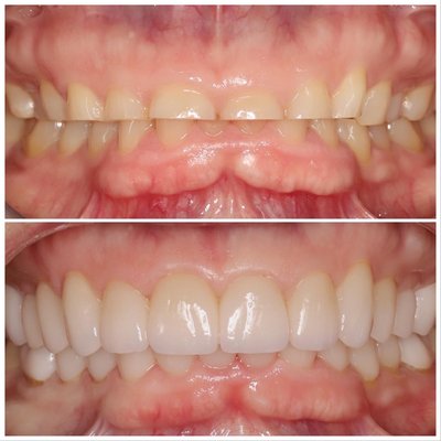 Full Mouth Aesthetic Rehabilitation - Functional and Cosmetic Reconstruction! New beautiful smile to match our beautiful patient. Full Mouth Aesthetic Rehabilitation - Functional and Cosmetic Reconstruction! New beautiful smile to match our beautiful patient.