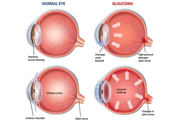Glaucoma Care - At Nova Eye Institute, we offer advanced glaucoma diagnosis & personalized treatment plans, using the latest technology to monitor & protect your vision through medications, laser procedures, or surgery as needed. Glaucoma Care - At Nova Eye Institute, we offer advanced glaucoma diagnosis & personalized treatment plans, using the latest technology to monitor & protect your vision through medications, laser procedures, or surgery as needed.