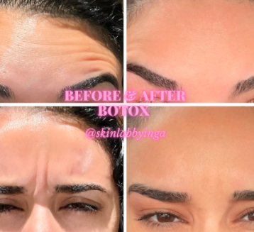Forehead Bototx line reduction - Forehead Botox:

First 20 units $175 each additional unit $10.50