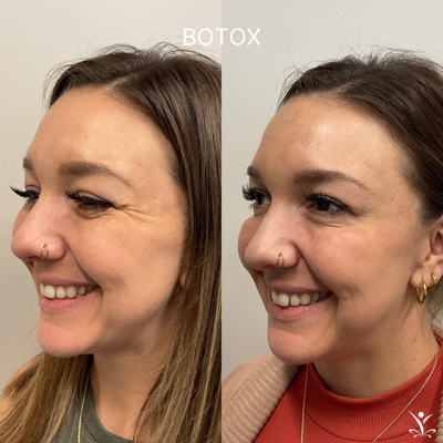 Botox Before and After's - Botox before and after's. Botox Before and After's - Botox before and after's.