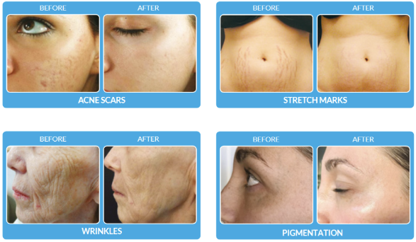 Microchanneling/microneedling Services - Microchanneling, also known as microneedling or collagen induction therapy, is a cosmetic procedure that involves the use of a device with fine needles to create controlled micro-injuries on the skin's surface. The purpose of these micro-injuries is to stimulate the body's natural wound-healing processes, leading to the production of collagen and elastin. Collagen and elastin are essential proteins that contribute to the skin's structure, firmness, and elasticity. We use one of the highest quality and quietest microneedling devices available with serums backed with science developed by Procell Therapies. Microchanneling/microneedling Services - Microchanneling, also known as microneedling or collagen induction therapy, is a cosmetic procedure that involves the use of a device with fine needles to create controlled micro-injuries on the skin's surface. The purpose of these micro-injuries is to stimulate the body's natural wound-healing processes, leading to the production of collagen and elastin. Collagen and elastin are essential proteins that contribute to the skin's structure, firmness, and elasticity. We use one of the highest quality and quietest microneedling devices available with serums backed with science developed by Procell Therapies.