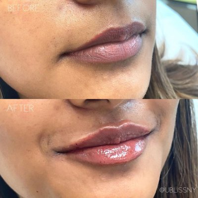 Lip Filler - estylane Kysse is a new FDA-approved hyaluronic acid (HA) lip filler designed to enhance lip volume and minimize the appearance of fine lines above the upper lip with a natural look and feel. Restylane Kysse is the first HA lip filler formulated with XpresHAn Technology designed for excellent tissue integration that allows individuals to maintain their natural-looking expressions. Lip Filler - estylane Kysse is a new FDA-approved hyaluronic acid (HA) lip filler designed to enhance lip volume and minimize the appearance of fine lines above the upper lip with a natural look and feel. Restylane Kysse is the first HA lip filler formulated with XpresHAn Technology designed for excellent tissue integration that allows individuals to maintain their natural-looking expressions.
