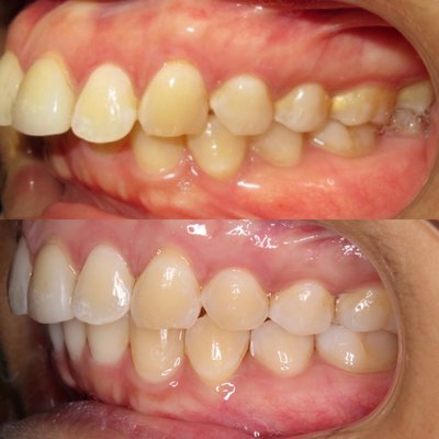 Overbite and crowding correction done with Invisalign - Invisalign treatment done to correct overbite and crowding Overbite and crowding correction done with Invisalign - Invisalign treatment done to correct overbite and crowding