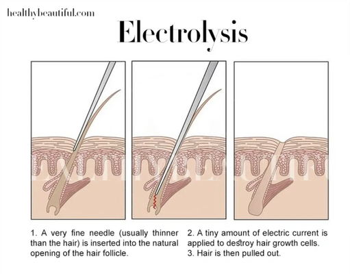 Electrolysis - ELECTROLYSIS METHODS:

1.   THERMOLYSIS:       

A method that uses high frequency current to produce heat that cauterizes and destroys the dermal papilla. One sterile probe is used in this process.

2.   THE BLEND:

A combination of Galvanic and Thermolysis procedures.