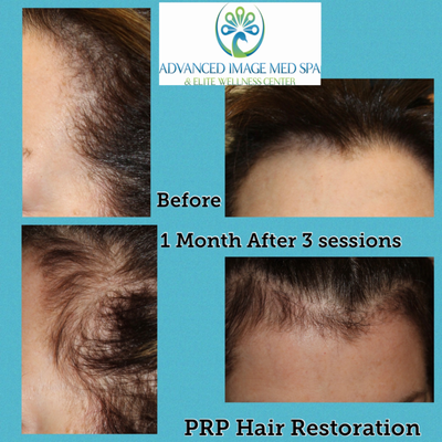 Hair Restoration using PRP (your own blood) - The PRP serum is delivered into the scalp, stimulating follicles and improving the number of hairs per follicle, resulting in thicker, healthier hair. Unlike some treatments, such as certain drugs, there is no risk of side effects such as loss of libido or allergic reactions.