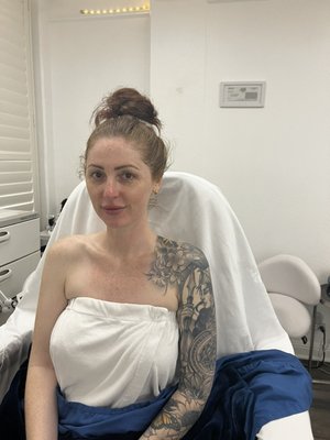 Hydrafacial - ✨💦 Reveal Radiant Skin with Our Hydrafacial Treatment! 💧✨
Ready to pamper your skin and unleash its natural glow? Our Hydrafacial treatment is the ultimate indulgence for a complexion that radiates beauty and vitality. 🌟🧖♀️
Why Choose Our Hydrafacial?
1️⃣ Deep Cleansing: Our Hydrafacial deeply cleanses, exfoliates, and hydrates the skin, leaving it refreshed and rejuvenated.
2️⃣ Customized Care: Tailored to your specific skin concerns, our Hydrafacial treatment addresses issues such as fine lines, wrinkles, uneven texture, and more.
3️⃣ Immediate Results: Experience instant improvement in skin tone, texture, and overall appearance after just one session.
Ready to experience the transformative power of a Hydrafacial? Contact us today to schedule your appointment and unveil the radiant skin you deserve! 📞🌺 #Hydrafacial #Skincare
Treat yourself to the luxury of radiant skin with our Hydrafacial treatment! 💦✨ #SkincareGoals #GlowingComplexion Hydrafacial - ✨💦 Reveal Radiant Skin with Our Hydrafacial Treatment! 💧✨
Ready to pamper your skin and unleash its natural glow? Our Hydrafacial treatment is the ultimate indulgence for a complexion that radiates beauty and vitality. 🌟🧖♀️
Why Choose Our Hydrafacial?
1️⃣ Deep Cleansing: Our Hydrafacial deeply cleanses, exfoliates, and hydrates the skin, leaving it refreshed and rejuvenated.
2️⃣ Customized Care: Tailored to your specific skin concerns, our Hydrafacial treatment addresses issues such as fine lines, wrinkles, uneven texture, and more.
3️⃣ Immediate Results: Experience instant improvement in skin tone, texture, and overall appearance after just one session.
Ready to experience the transformative power of a Hydrafacial? Contact us today to schedule your appointment and unveil the radiant skin you deserve! 📞🌺 #Hydrafacial #Skincare
Treat yourself to the luxury of radiant skin with our Hydrafacial treatment! 💦✨ #SkincareGoals #GlowingComplexion