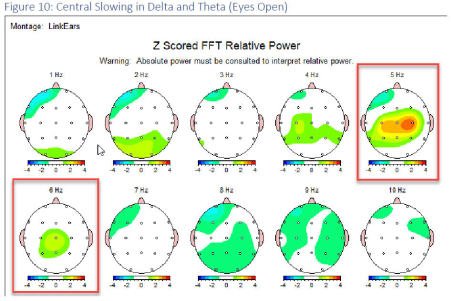 ADHD Treatment - ADHD is one of the most widely studied conditions in the field of neurofeedback. Based off of EEG findings, ADHD has several variations. The most common variant of ADHD is alpha slowing, where the brain’s processing speed is slower than others of a similar age. This is seen in an elevated theta/beta ratio, as seen here, where the theta/beta ratio is elevated in the right frontal region. People with this variant of ADHD may experience difficulty performing cognitive tasks and staying focused. Often times they feel sluggish and have a decreased capacity to pay attention to directions.
In such a variant, the goal is to decrease the theta/beta ratio in the region of the brain where it is elevated. This shift in brainwave patterns may correlated with increased reading and verbal comprehension, as well as renewed capacity to successfully perform cognitively challenging tasks.
While this is one variant of ADHD, our clinic treats all variants of the disorder. Each individual is different and there is often more than one treatment goal to target. This is why a thorough assessment of your individual brain is so critical to your success. Our intake procedure includes the use of a QEEG brain map to ensure that you are receiving appropriate and personalized treatment. ADHD Treatment - ADHD is one of the most widely studied conditions in the field of neurofeedback. Based off of EEG findings, ADHD has several variations. The most common variant of ADHD is alpha slowing, where the brain’s processing speed is slower than others of a similar age. This is seen in an elevated theta/beta ratio, as seen here, where the theta/beta ratio is elevated in the right frontal region. People with this variant of ADHD may experience difficulty performing cognitive tasks and staying focused. Often times they feel sluggish and have a decreased capacity to pay attention to directions.
In such a variant, the goal is to decrease the theta/beta ratio in the region of the brain where it is elevated. This shift in brainwave patterns may correlated with increased reading and verbal comprehension, as well as renewed capacity to successfully perform cognitively challenging tasks.
While this is one variant of ADHD, our clinic treats all variants of the disorder. Each individual is different and there is often more than one treatment goal to target. This is why a thorough assessment of your individual brain is so critical to your success. Our intake procedure includes the use of a QEEG brain map to ensure that you are receiving appropriate and personalized treatment.
