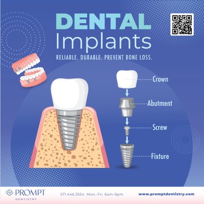 Dental implant - We are committed to providing quality healthcare to families located in the Reston area and treat patients of all ages. We provide comprehensive solutions for our patients' oral health needs. Believing in the importance of listening to our patients, we take the time to truly understand each person's needs, goals, and lifestyle. By understanding our patients' objectives we can provide solutions that will improve their health while transforming their smile into something bright and beautiful.

Prompt Dentistry is located at 12005 Sunrise Valley Dr. Suite 130, Reston, VA. We are currently accepting new patients, and you can schedule an appointment by calling 571-446-3554