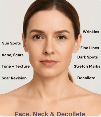 What + Where Microneedling Treats - Microneedling is commonly used on the face, neck, and décolleté, as well as the hands, to treat concerns such as fine lines, wrinkles, acne scars, enlarged pores, sun spots, dark spots, and uneven skin tone. It’s also effective in reducing the appearance of stretch marks on areas such as the abdomen, thighs, and the backs of the arms.
By stimulating collagen and elastin production, microneedling helps rejuvenate skin from within—delivering a healthier, more youthful look.
Products Offered: Collagen P.I.N, EXO|E (a concentrated exosome with anti inflammatory factors, promotes faster healing and enhanced regenerative results)
How Long It Lasts: Results continue to appear for 6 weeks post-treatment. Some clients may need a series of up to 3 treatments to reach optimal results. What + Where Microneedling Treats - Microneedling is commonly used on the face, neck, and décolleté, as well as the hands, to treat concerns such as fine lines, wrinkles, acne scars, enlarged pores, sun spots, dark spots, and uneven skin tone. It’s also effective in reducing the appearance of stretch marks on areas such as the abdomen, thighs, and the backs of the arms.
By stimulating collagen and elastin production, microneedling helps rejuvenate skin from within—delivering a healthier, more youthful look.
Products Offered: Collagen P.I.N, EXO|E (a concentrated exosome with anti inflammatory factors, promotes faster healing and enhanced regenerative results)
How Long It Lasts: Results continue to appear for 6 weeks post-treatment. Some clients may need a series of up to 3 treatments to reach optimal results.