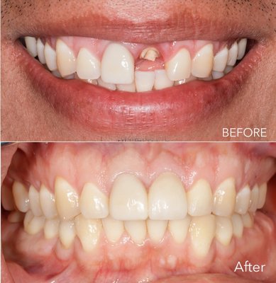 Smile Makeover - This Smile Makeover was done on a patient who fell and broke her tooth same day. Smile Makeover - This Smile Makeover was done on a patient who fell and broke her tooth same day.