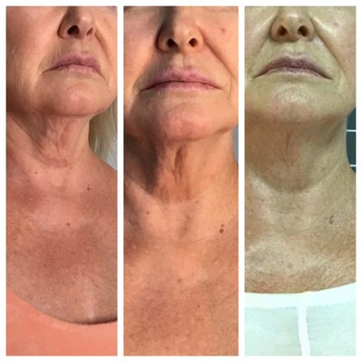 Neck & decollate lifting and tightening - Our client was concerned with their neck, so we spent a few sessions from their package to lift, re-texturize, drain the lymph nodes, boost collagen production and smoothen the fine lines we all get over time. Photos from left to right: first session, third session and fourth session.
In addition, we use Epionce products during the process which penetrates deeper during our treatment, which has clinically proven results over skincare brands like Obagi! The same technology we use for lymphatic drainage on your body is suited for your face. Neck & decollate lifting and tightening - Our client was concerned with their neck, so we spent a few sessions from their package to lift, re-texturize, drain the lymph nodes, boost collagen production and smoothen the fine lines we all get over time. Photos from left to right: first session, third session and fourth session.
In addition, we use Epionce products during the process which penetrates deeper during our treatment, which has clinically proven results over skincare brands like Obagi! The same technology we use for lymphatic drainage on your body is suited for your face.