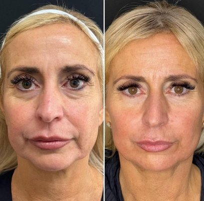 NeoGen - NeoGen PSR is a one-of-a-kind skin resurfacing treatment that improves dermal elasticity to firm, tone, and smooth the skin on your face, neck, and body. It is the first and only treatment clinically proven to regenerate skin rather than simply improve its appearance.
NeoGen skin regeneration addresses:
Fine lines and deep wrinkles
Pigmentation, age spots, and sun damage
Scarring on the face and body
Loose skin on the upper and lower eyelids
Large pores
Actinic and seborrheic keratosis
Active acne and acne scars
Skin laxity in your jawline, jowl, and mid-face NeoGen - NeoGen PSR is a one-of-a-kind skin resurfacing treatment that improves dermal elasticity to firm, tone, and smooth the skin on your face, neck, and body. It is the first and only treatment clinically proven to regenerate skin rather than simply improve its appearance.
NeoGen skin regeneration addresses:
Fine lines and deep wrinkles
Pigmentation, age spots, and sun damage
Scarring on the face and body
Loose skin on the upper and lower eyelids
Large pores
Actinic and seborrheic keratosis
Active acne and acne scars
Skin laxity in your jawline, jowl, and mid-face