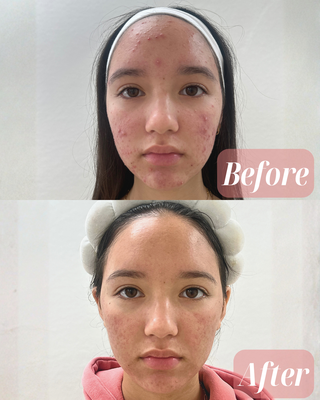 Acne Transformations - This acne transformation highlights the results of a customized treatment plan designed by Dr. Shadi. Through targeted medical-grade skincare and consistent care, this patient achieved clearer skin, reduced inflammation, and a smoother overall complexion. Our goal is to treat the root cause of acne and help each patient feel confident in their skin again. Acne Transformations - This acne transformation highlights the results of a customized treatment plan designed by Dr. Shadi. Through targeted medical-grade skincare and consistent care, this patient achieved clearer skin, reduced inflammation, and a smoother overall complexion. Our goal is to treat the root cause of acne and help each patient feel confident in their skin again.