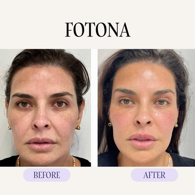 Lift and Tighten with Laser and Energy Devices - Our non-surgical skin tightening treatments use Morpheus8, Fotona laser, microneedling, and ProFound RF to lift and firm the face and neck. These collagen-stimulating treatments improve skin laxity, soften fine lines, and restore structure without surgery.
Ideal for early sagging and loss of elasticity, they deliver gradual, natural-looking lift and tightening. Lift and Tighten with Laser and Energy Devices - Our non-surgical skin tightening treatments use Morpheus8, Fotona laser, microneedling, and ProFound RF to lift and firm the face and neck. These collagen-stimulating treatments improve skin laxity, soften fine lines, and restore structure without surgery.
Ideal for early sagging and loss of elasticity, they deliver gradual, natural-looking lift and tightening.