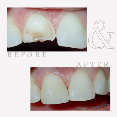 Before and After Photos - Dr. Feyock’s patients often express a deep trust in her and her abilities and know that they are receiving a very high level of compassionate care. Dr. Feyock’s carefully and precisely crafted dentistry, her focus on wellness from a whole health perspective, and her centered attention on each patient is what she is honored to provide for each and every one of her patients. Before and After Photos - Dr. Feyock’s patients often express a deep trust in her and her abilities and know that they are receiving a very high level of compassionate care. Dr. Feyock’s carefully and precisely crafted dentistry, her focus on wellness from a whole health perspective, and her centered attention on each patient is what she is honored to provide for each and every one of her patients.