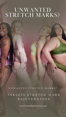 Inkless Stretch Mark Rejuvenation - Stretch Mark Camouflage Inkless or Inkless Stretch Mark Rejuvenation (ISR) Technique involves using a combination of our organic blend of oils and vitamins using a tattooing method to penetrate each individual stretch mark. This procedure is a more natural treatment that can be used for all stretch marks: red, purple and white. It is also preferable for the deeper scarring. We employ a mix of serums, organic oils and vitamins to improve cellular turnover, reconstruction, and rejuvenation of Fibroblast cells, collagen and elastin as it improves texture. As a result, clients will notice 20%-80% reduction of the appearance of stretch marks after one session (results vary by individual).
Most of our clients have no downtime and can return back to work right away! Inkless Stretch Mark Rejuvenation - Stretch Mark Camouflage Inkless or Inkless Stretch Mark Rejuvenation (ISR) Technique involves using a combination of our organic blend of oils and vitamins using a tattooing method to penetrate each individual stretch mark. This procedure is a more natural treatment that can be used for all stretch marks: red, purple and white. It is also preferable for the deeper scarring. We employ a mix of serums, organic oils and vitamins to improve cellular turnover, reconstruction, and rejuvenation of Fibroblast cells, collagen and elastin as it improves texture. As a result, clients will notice 20%-80% reduction of the appearance of stretch marks after one session (results vary by individual).
Most of our clients have no downtime and can return back to work right away!
