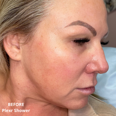 Hydrafacial Syndeo - Our spa is an authorized provider for Hydrafacia Syndeo, the newest model to provide our clients with only the best treatments Syndeo can offer. 100% guaranteed genuine Hydrafacial booster and serum. Enjoy a relaxing facial treatment with our experienced Hydrafacialist with ample training in Hydrafacial treatments.