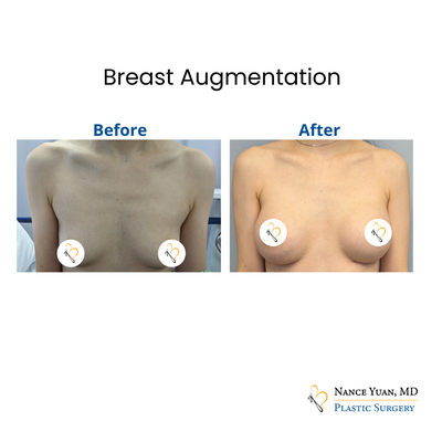 Breast Augmentation - Have you considered breast augmentation to enhance your body? Dr. Yuan will help you through the process, from selecting the size and the profile of your desired implants. Based on your stature and preferences, she'll help you find the right size that'll compliment you. Breast Augmentation - Have you considered breast augmentation to enhance your body? Dr. Yuan will help you through the process, from selecting the size and the profile of your desired implants. Based on your stature and preferences, she'll help you find the right size that'll compliment you.