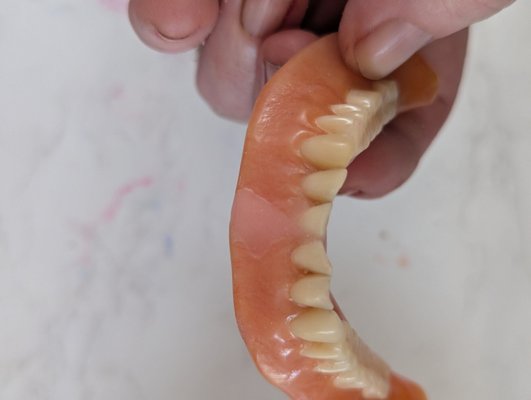 Before and after photos of lower complete denture fractured - The photos are before and after of a CD complete denture broken after wear. Majority of photos are during and after finishing of repair at TWDR Before and after photos of lower complete denture fractured - The photos are before and after of a CD complete denture broken after wear. Majority of photos are during and after finishing of repair at TWDR