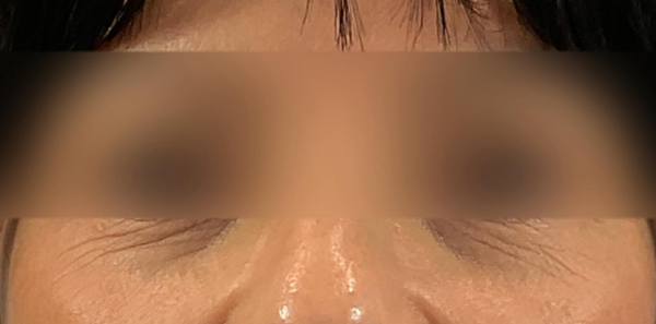 Morpheus8 for Eyes Treatment - Imagine waking up every morning with smoother, tighter under-eye skin that defies the passage of time. Morpheus8 makes this dream a reality, providing long-lasting benefits that leave you looking refreshed and feeling your best.
Morpheus8 combines the power of microneedling and radiofrequency technology to target those troublesome under-eye areas. This non-invasive procedure stimulates collagen production, restoring your skin's youthful elasticity and firmness.
Book Your Appointment:
(310) 272-9988
https://drdoris.com
Beverly Hills Morpheus8 for Eyes Treatment - Imagine waking up every morning with smoother, tighter under-eye skin that defies the passage of time. Morpheus8 makes this dream a reality, providing long-lasting benefits that leave you looking refreshed and feeling your best.
Morpheus8 combines the power of microneedling and radiofrequency technology to target those troublesome under-eye areas. This non-invasive procedure stimulates collagen production, restoring your skin's youthful elasticity and firmness.
Book Your Appointment:
(310) 272-9988
https://drdoris.com
Beverly Hills
