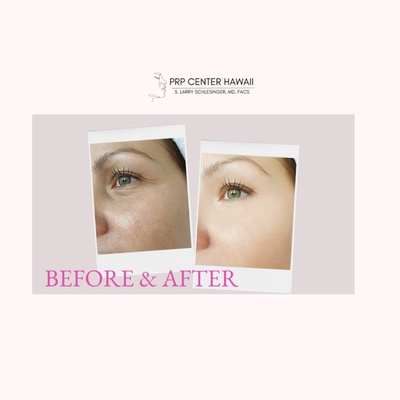Before & After Photos - Non-Surgical
Chin Filler
Dermal Fillers
Injectables
Lip Fillers
Non-Surgical Rhinoplasty
PRP Hair Restoration