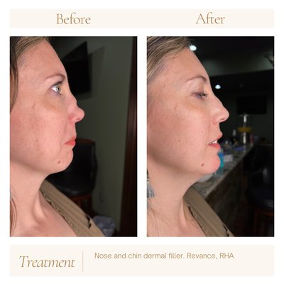 filler and threads - Dermal filler can be placed in the nose to help contour the nose. PDO threads help build the bridge.