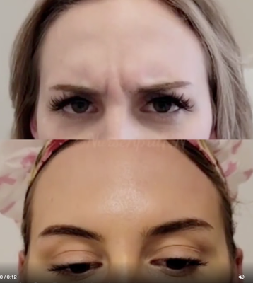Botox Injections for Wrinkles - Botox, Jeauveau, and Dysport injections to decrease the appearance of facial mimetic lines and to prevent them from becoming more pronounced over time. Injections performed by nurse injectors Natalie and April. Visit their instagram pages to view more work  @NatalieKay_RN  and @NurseAprilRN