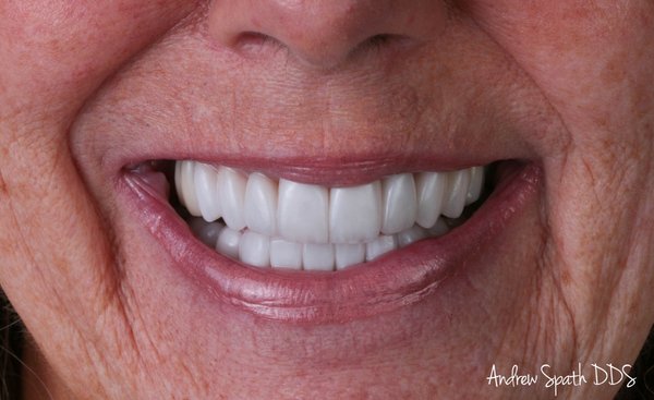 Full Mouth Reconstruction in Newport Beach, CA - This individual had full mouth reconstruction for cosmetic reasons and also to manage her bite. A bad bite can lead to gum disease. It is important to have all forces equally disbursed. This is referred to as the occlusion and it is why you always want to see an experienced dentist in Newport Beach, CA for complex care cases.