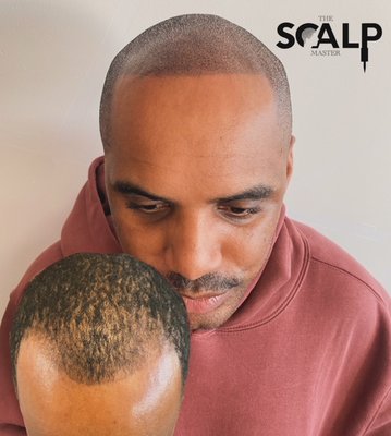 Before & After - Scalp Micropigmentation (SMP®) Is an innovative solution for a variety of hair loss types. This tattoo method replicates the appearance of thicker, fuller hair for men and women.
The Scalp Master creates a natural pattern that’s specifically designed for your every day needs & style, according to the characteristics of your hair loss and color of hair using sophisticated SMP techniques and technology. Before & After - Scalp Micropigmentation (SMP®) Is an innovative solution for a variety of hair loss types. This tattoo method replicates the appearance of thicker, fuller hair for men and women.
The Scalp Master creates a natural pattern that’s specifically designed for your every day needs & style, according to the characteristics of your hair loss and color of hair using sophisticated SMP techniques and technology.