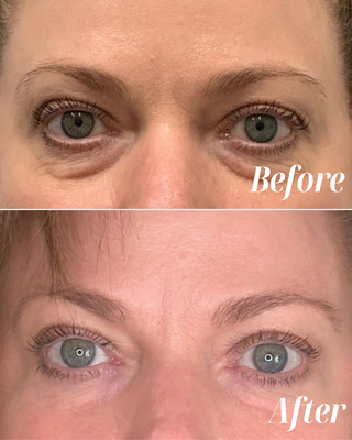 PRP and Bio-Gel Treatments - Revitalize your skin with PRP and Bio-Gel treatments at Dr. Shadi Concierge MedSpa! These powerful treatments harnesses your body’s natural healing properties with PRP/PRF injections and Bio-Gel which is created from your platelets and help with volume loss, diminish dark circles and lead to overall rejuvenation. PRP and Bio-Gel Treatments - Revitalize your skin with PRP and Bio-Gel treatments at Dr. Shadi Concierge MedSpa! These powerful treatments harnesses your body’s natural healing properties with PRP/PRF injections and Bio-Gel which is created from your platelets and help with volume loss, diminish dark circles and lead to overall rejuvenation.